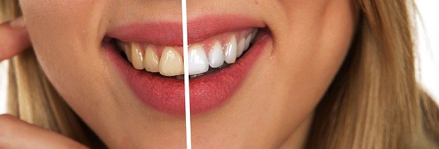 tooth discoloration causes